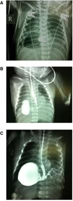 Analysis of imaging in pediatric bronchopulmonary foregut malformations with literature review: case reports